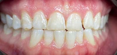 Worn and decayed smile before cosmetic dentistry