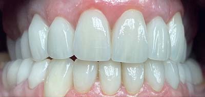 Healthy and flawlessly repaired smile