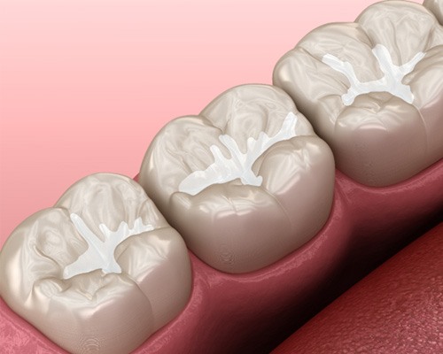 Illustration of dental sealants on molars