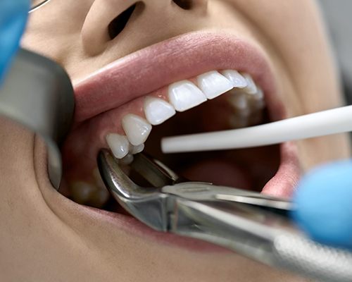 procedure for tooth extractions in Bedford  