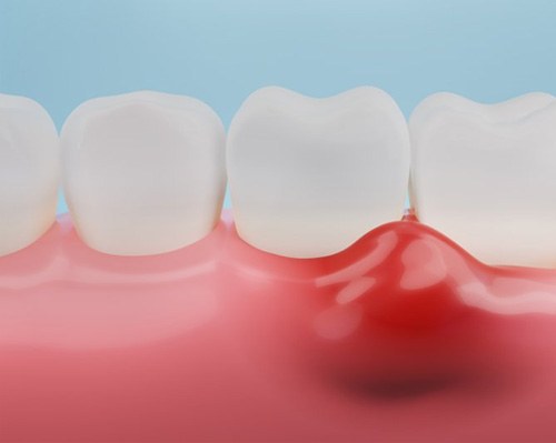 Illustration of inflamed gums