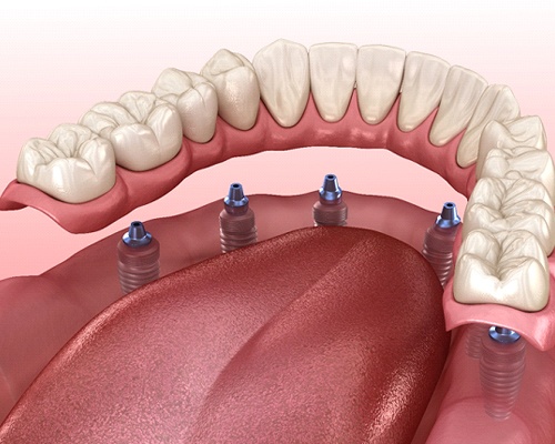 Implant denture for lower arch, supported by six implants