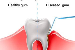 diagram of healthy and infected gums