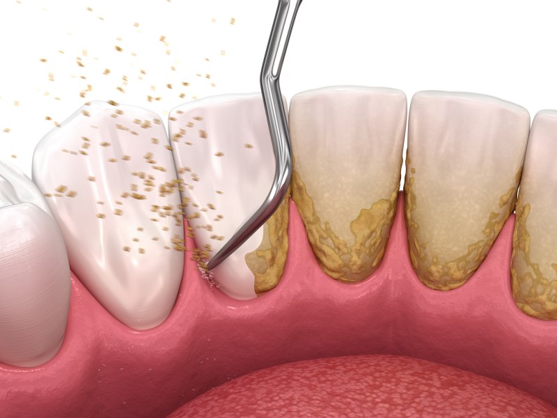 Digital illustration of scaling & root planing